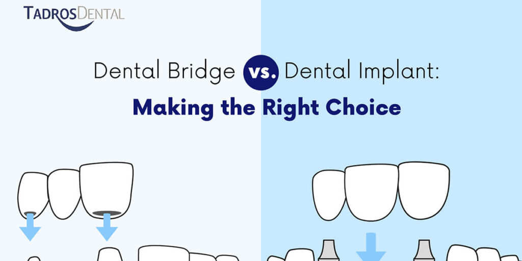 Dental Bridge vs. Implant: Making the Right Choice