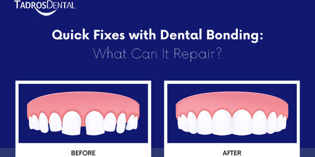 Quick Fixes with Dental Bonding: What Can It Repair?