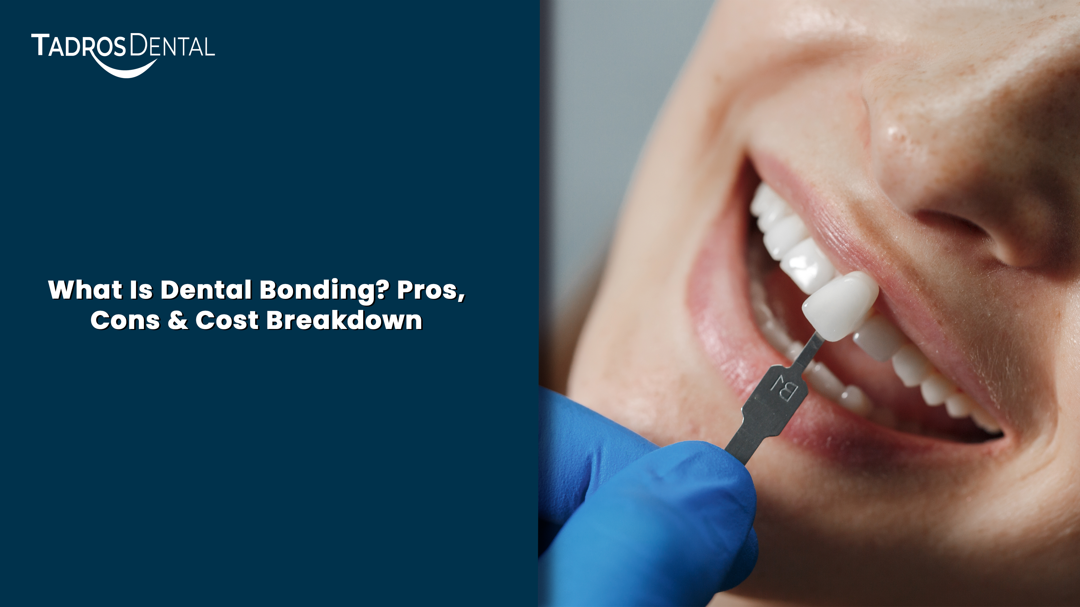 What Is Dental Bonding? Pros, Cons & Cost Breakdown