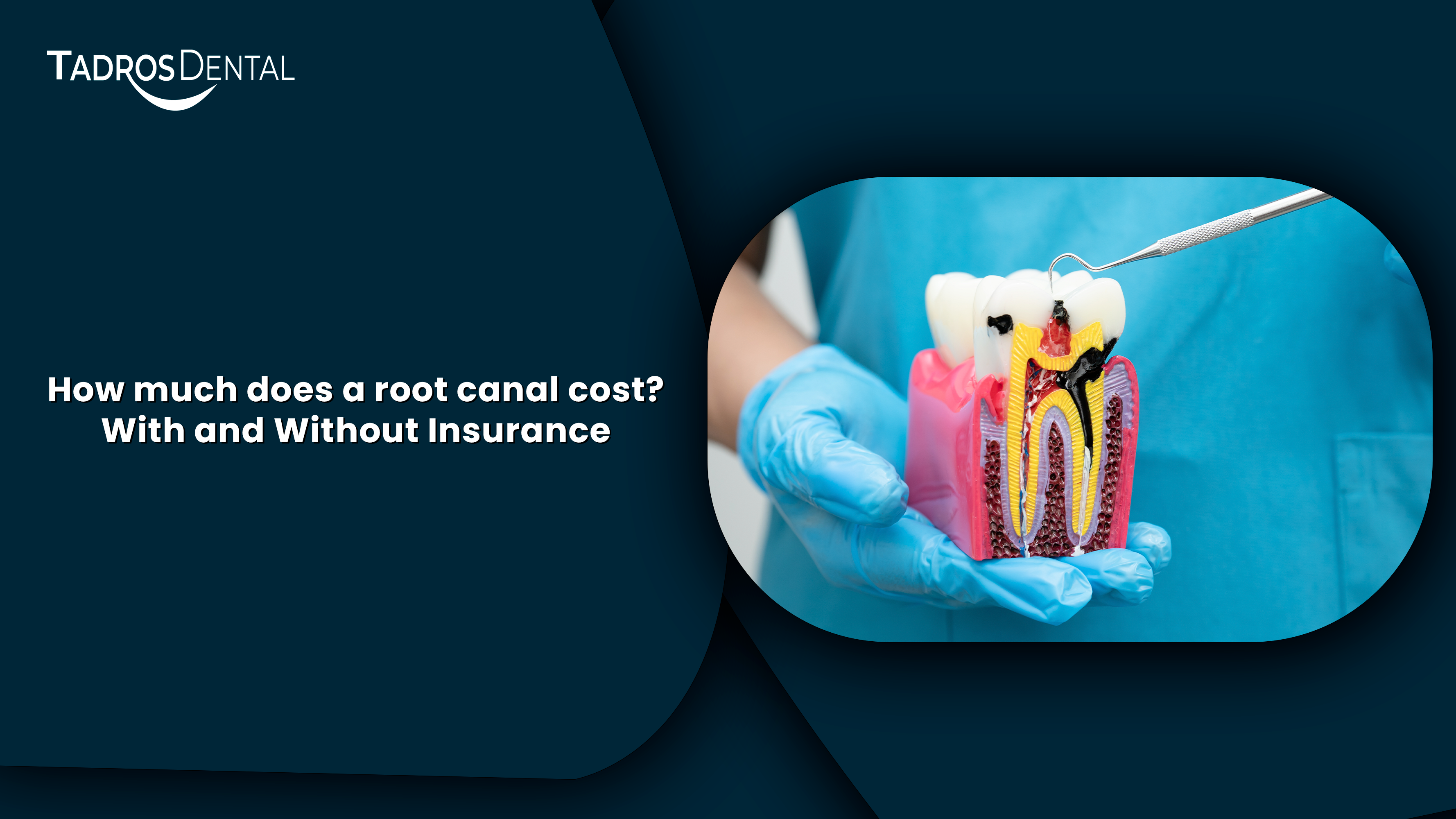 Root Canal Cost