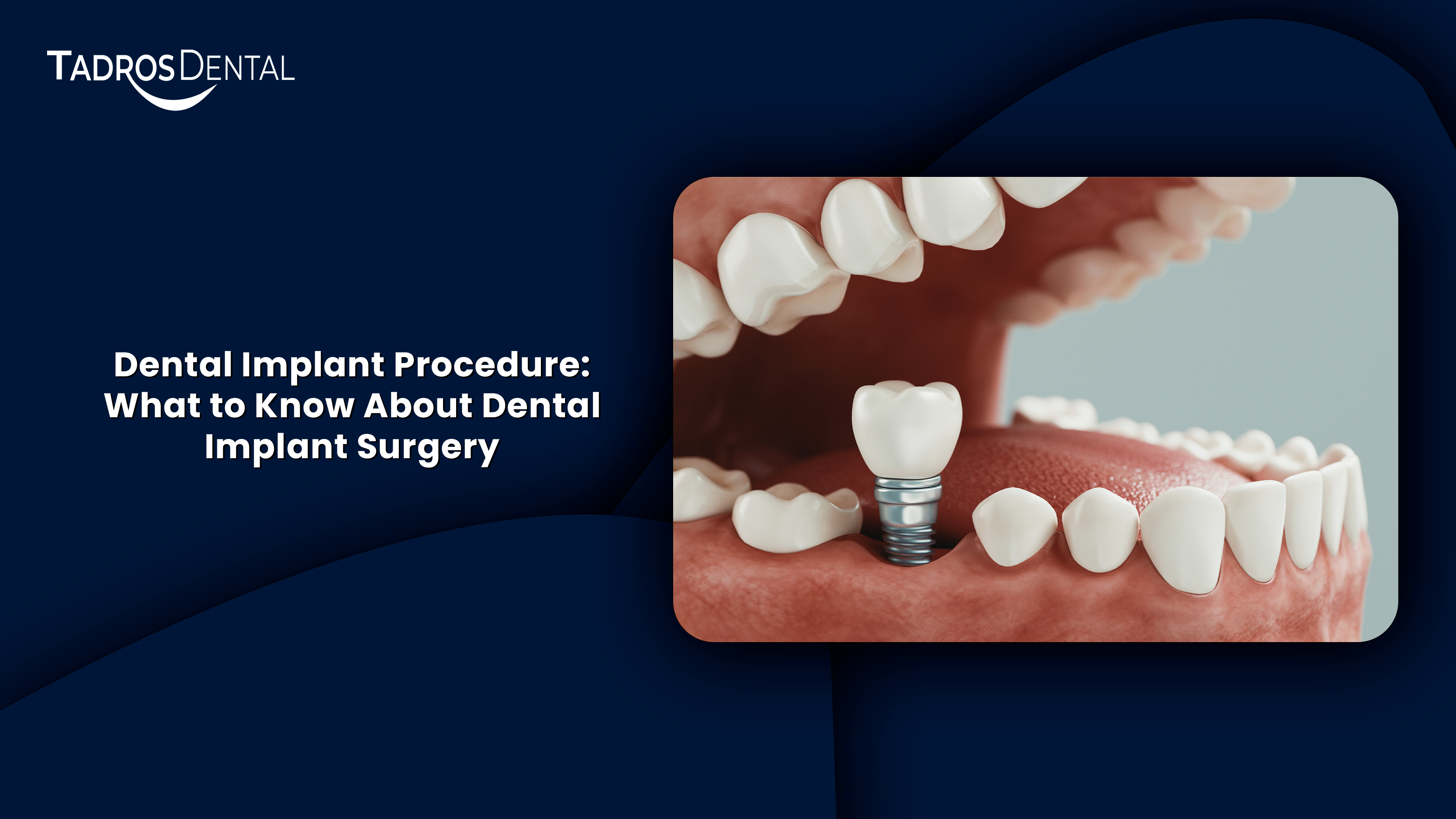 Dental Implant Procedure: What to Know About Dental Implant Surgery