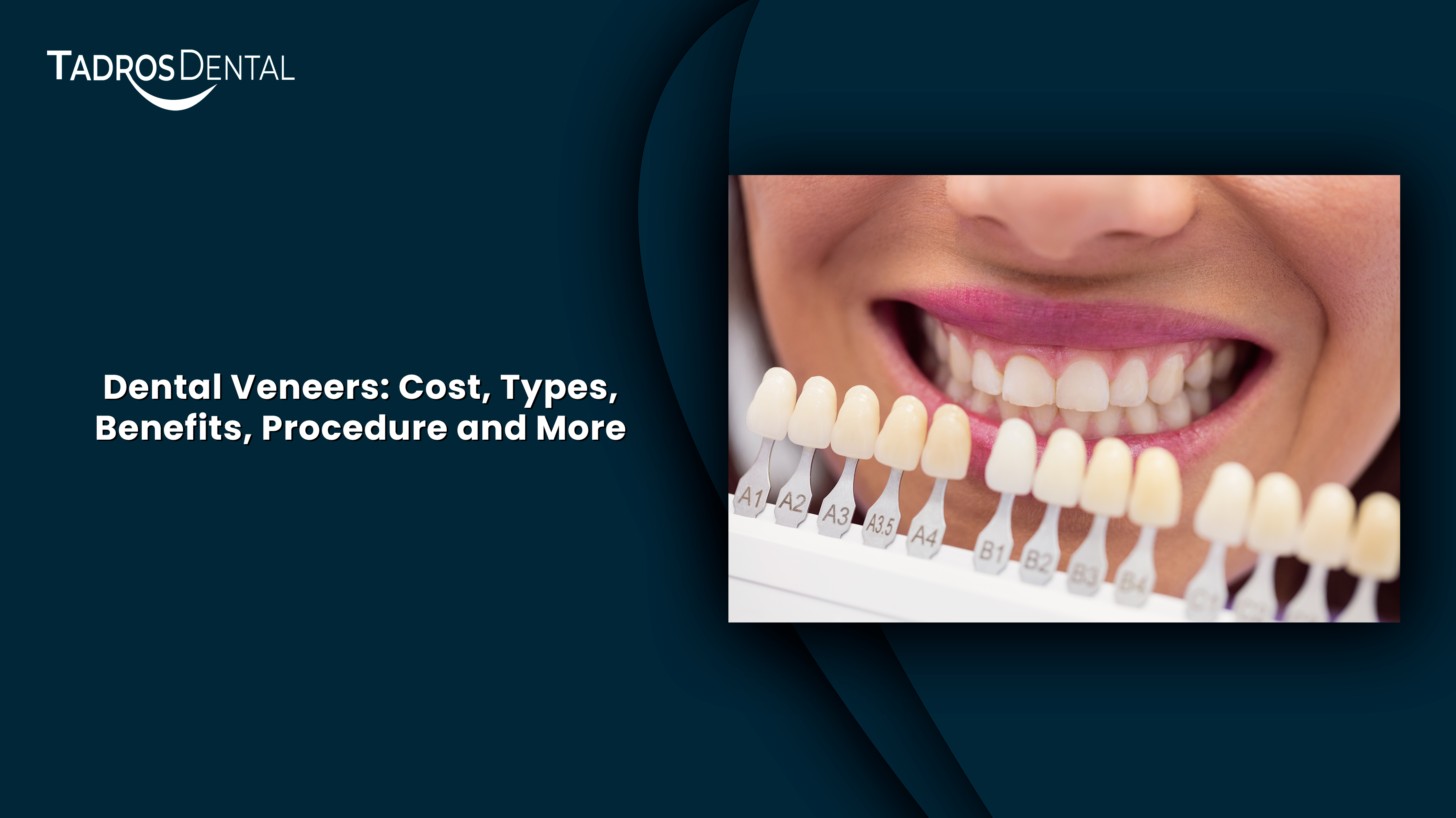 Dental Veneers Detailed Guide