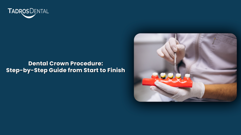 Dental Crown Procedure: A Step-by-Step Guide from Start to Finish