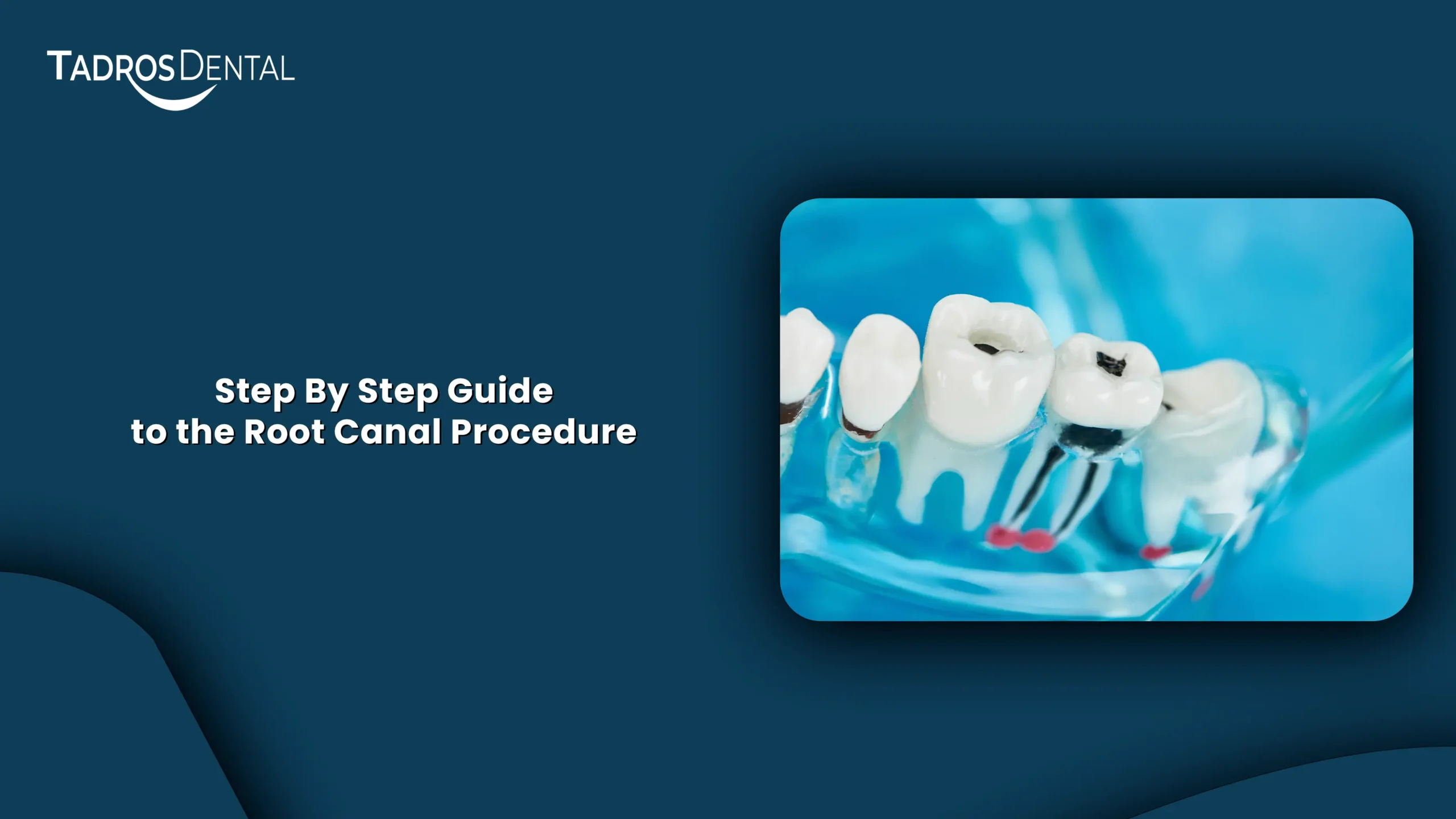Root Canal Process
