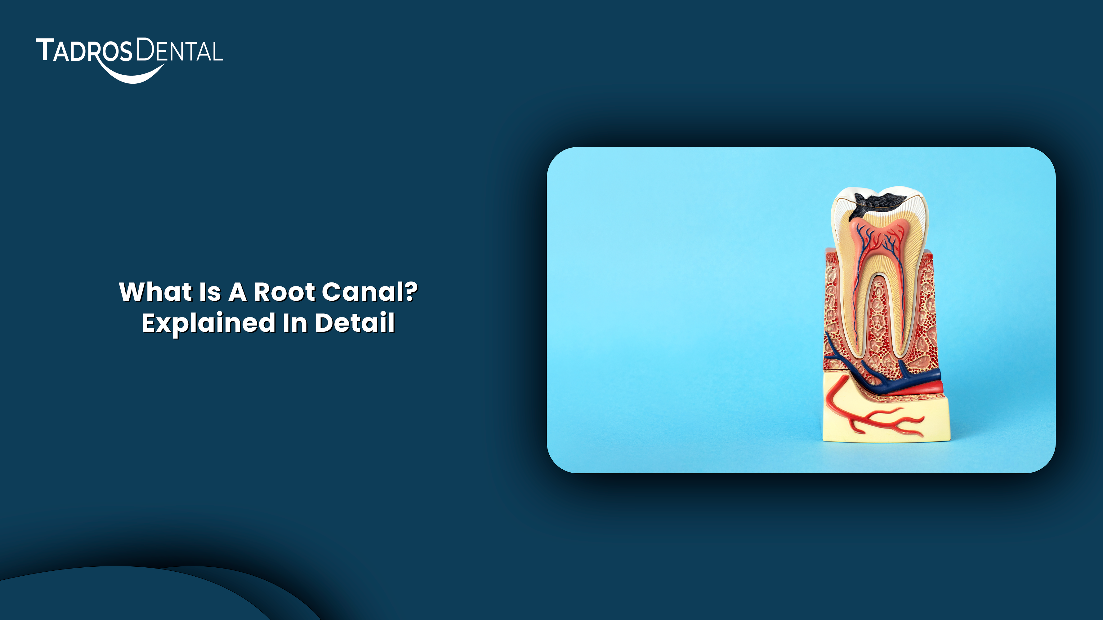 What is a Root Canal?