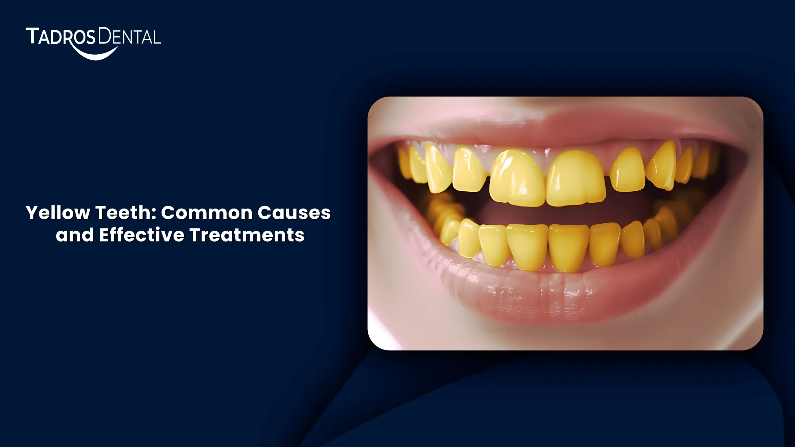 Yellow Teeth: Common Causes and Effective Treatments