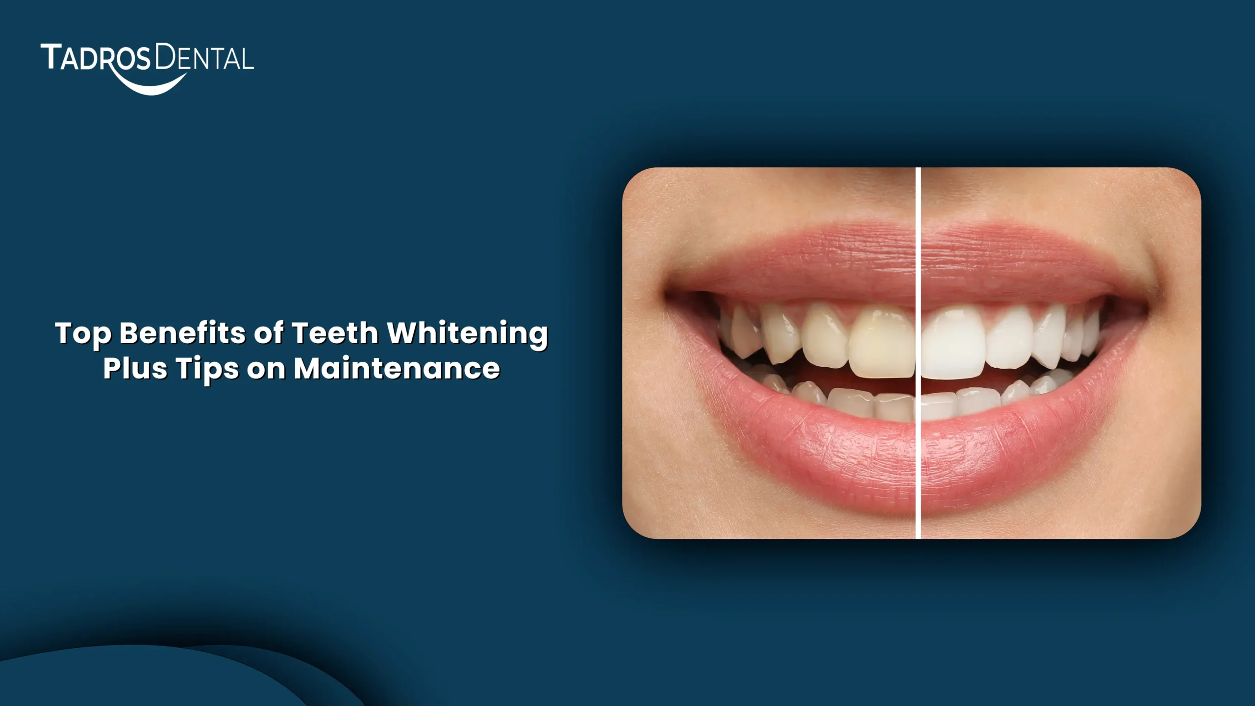 Benefits of Teeth Whitening