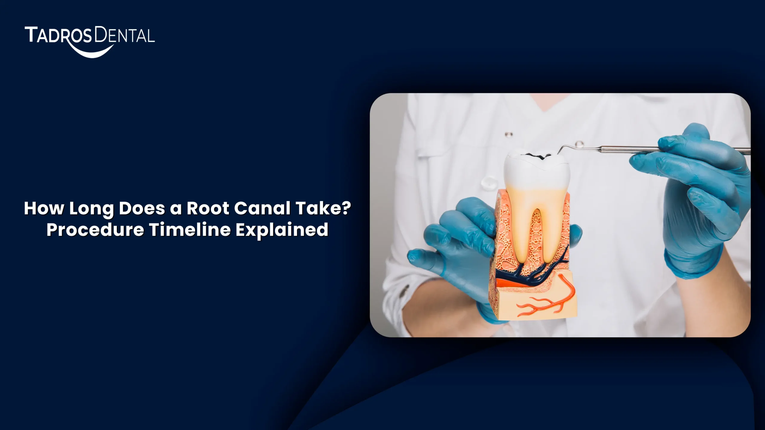 How Long Does a Root Canal Take