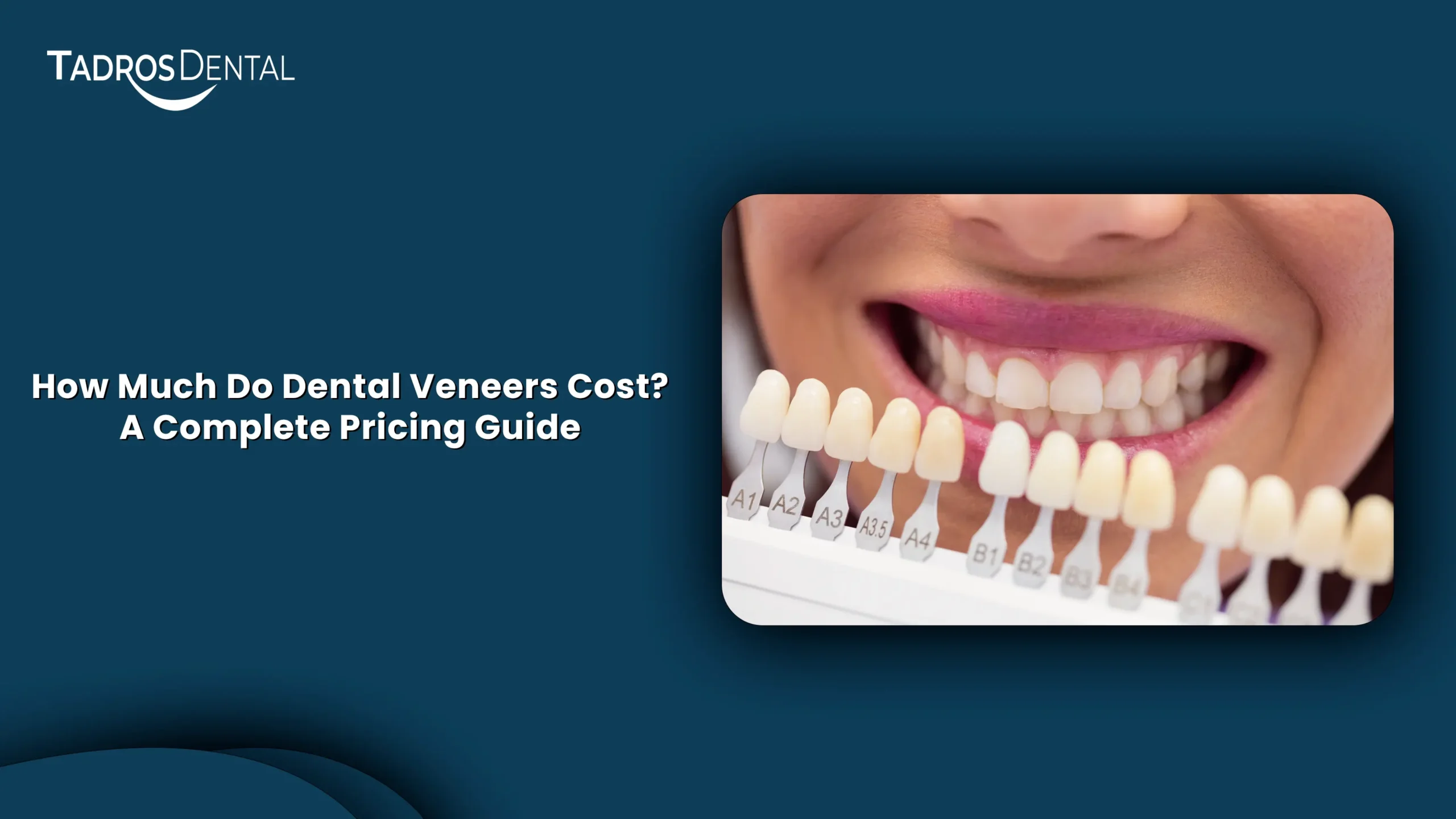 How Much Do Dental Veneers Cost