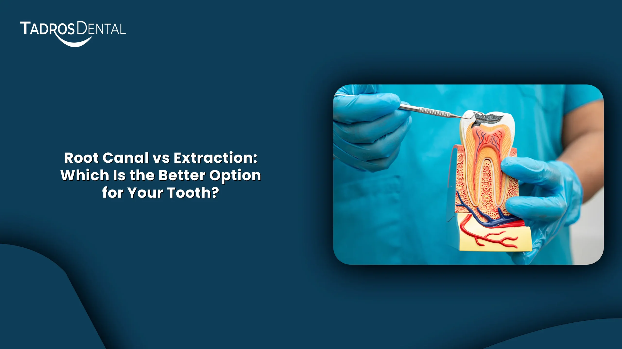 Root Canal vs Extraction: