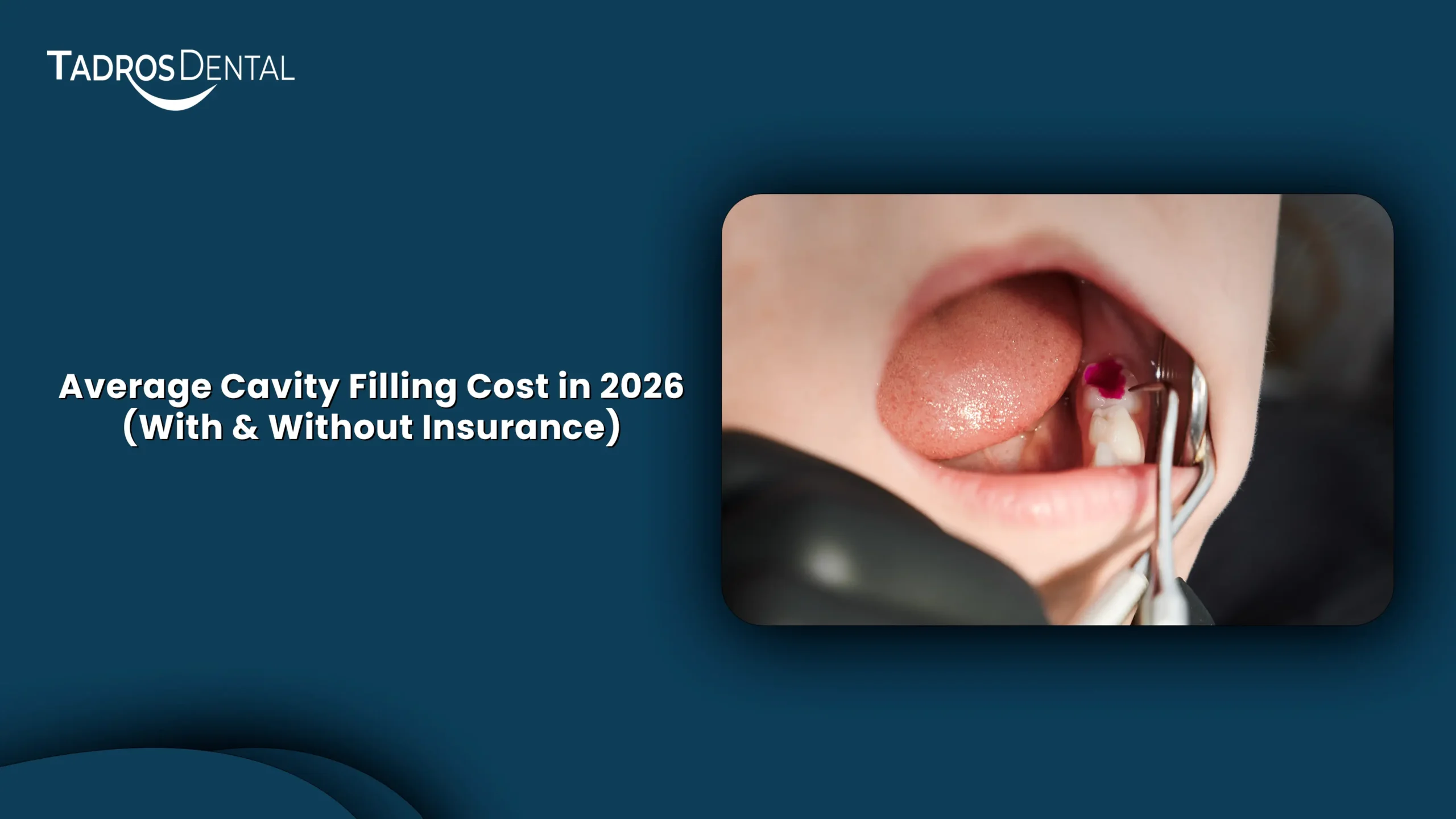 Average Cavity Filling Cost in 2026 (With & Without Insurance)