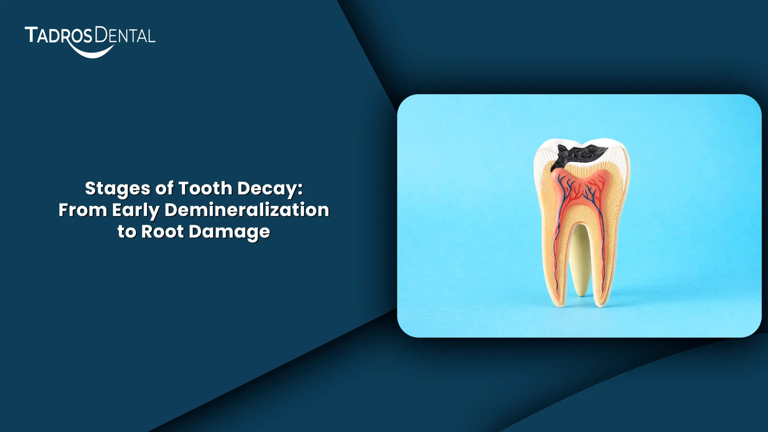 Stages of Tooth Decay: From Early Demineralization to Root Damage