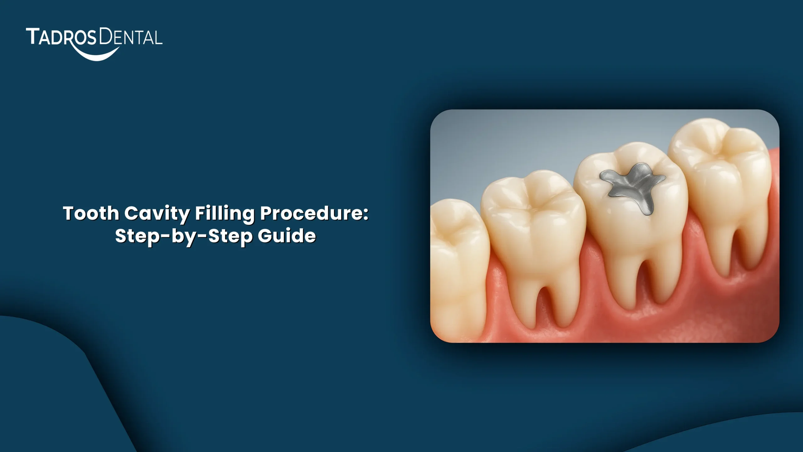 Tooth Cavity Filling