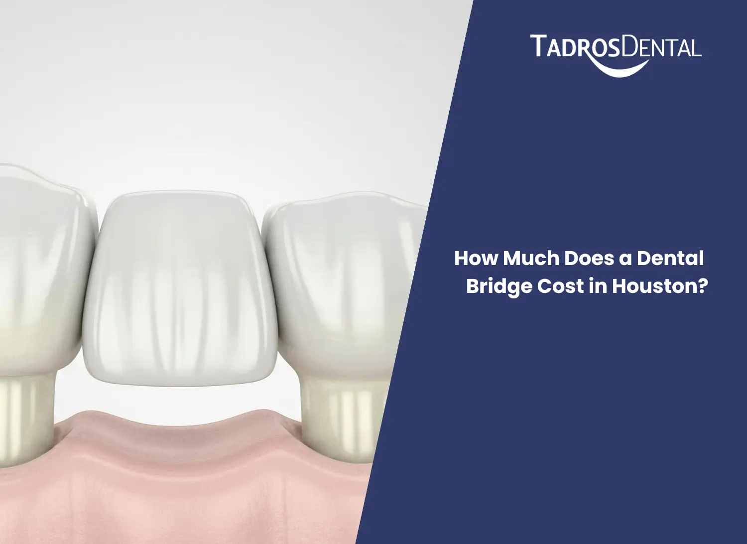 How Much Does a Dental Bridge Cost in Houston?