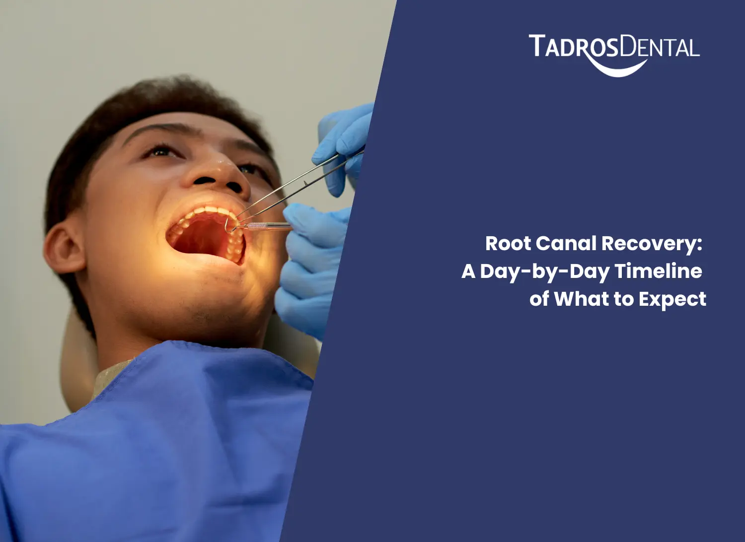 Root Canal Recovery: A Day-By-Day Timeline Of What To Expect