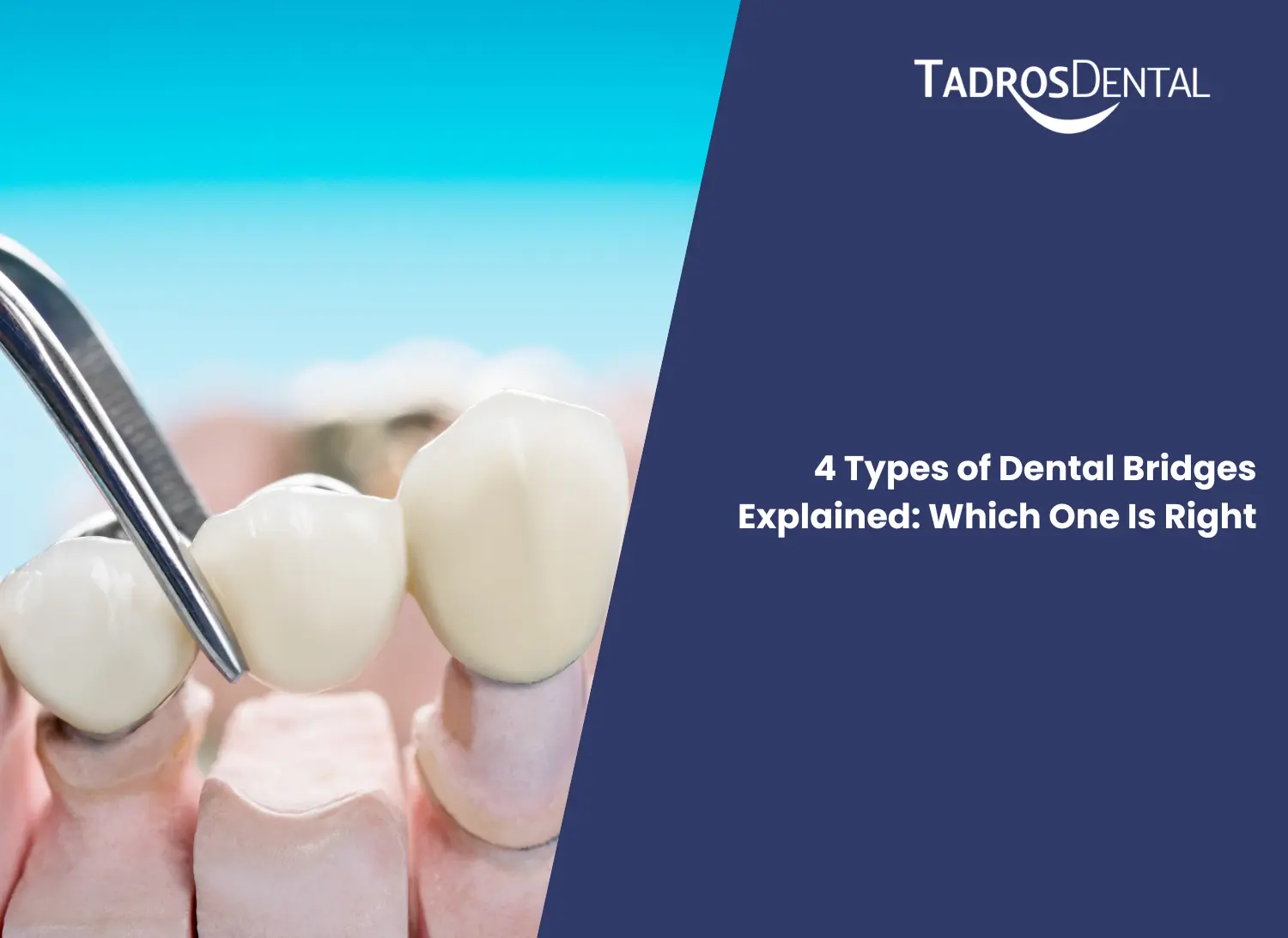4 Types of Dental Bridges Explained: Which One Is Right