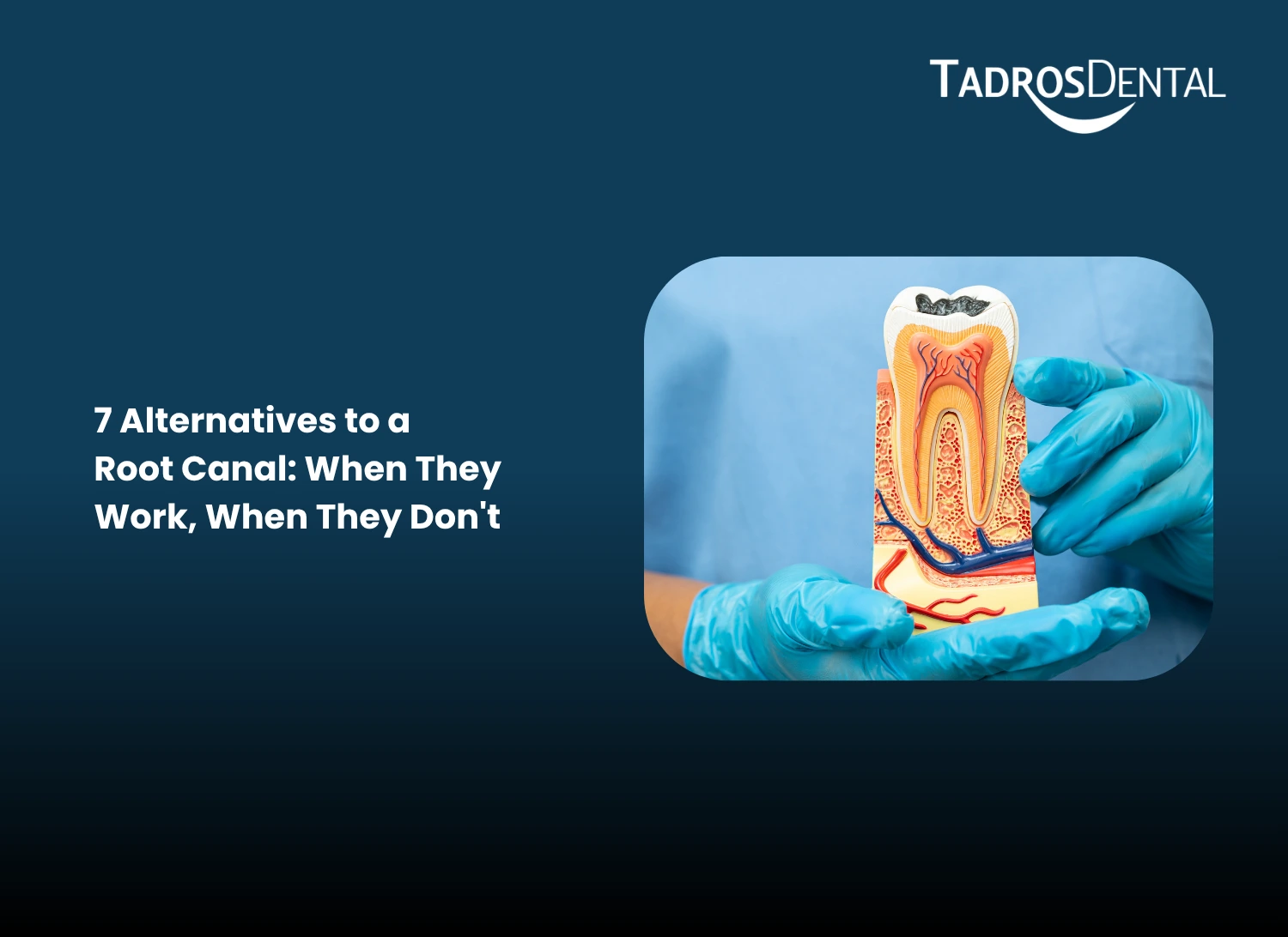 7 Alternatives to a Root Canal When They Work, When They Dont
