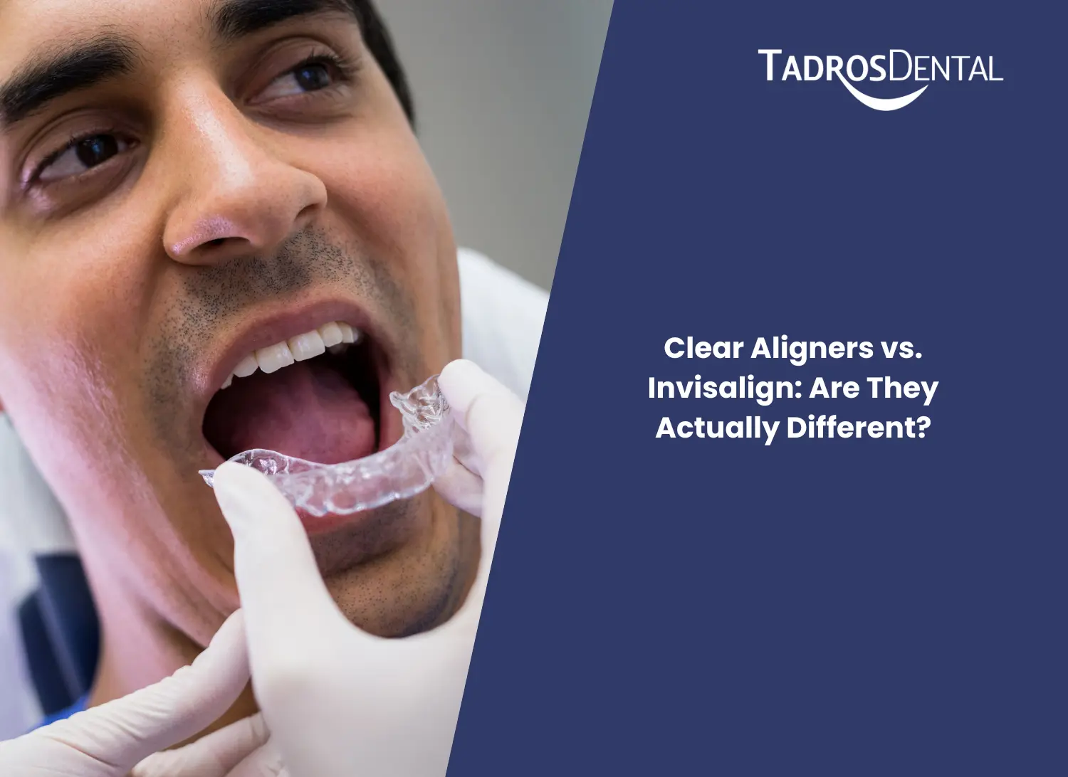 Clear Aligners vs. Invisalign: Are They Actually Different?
