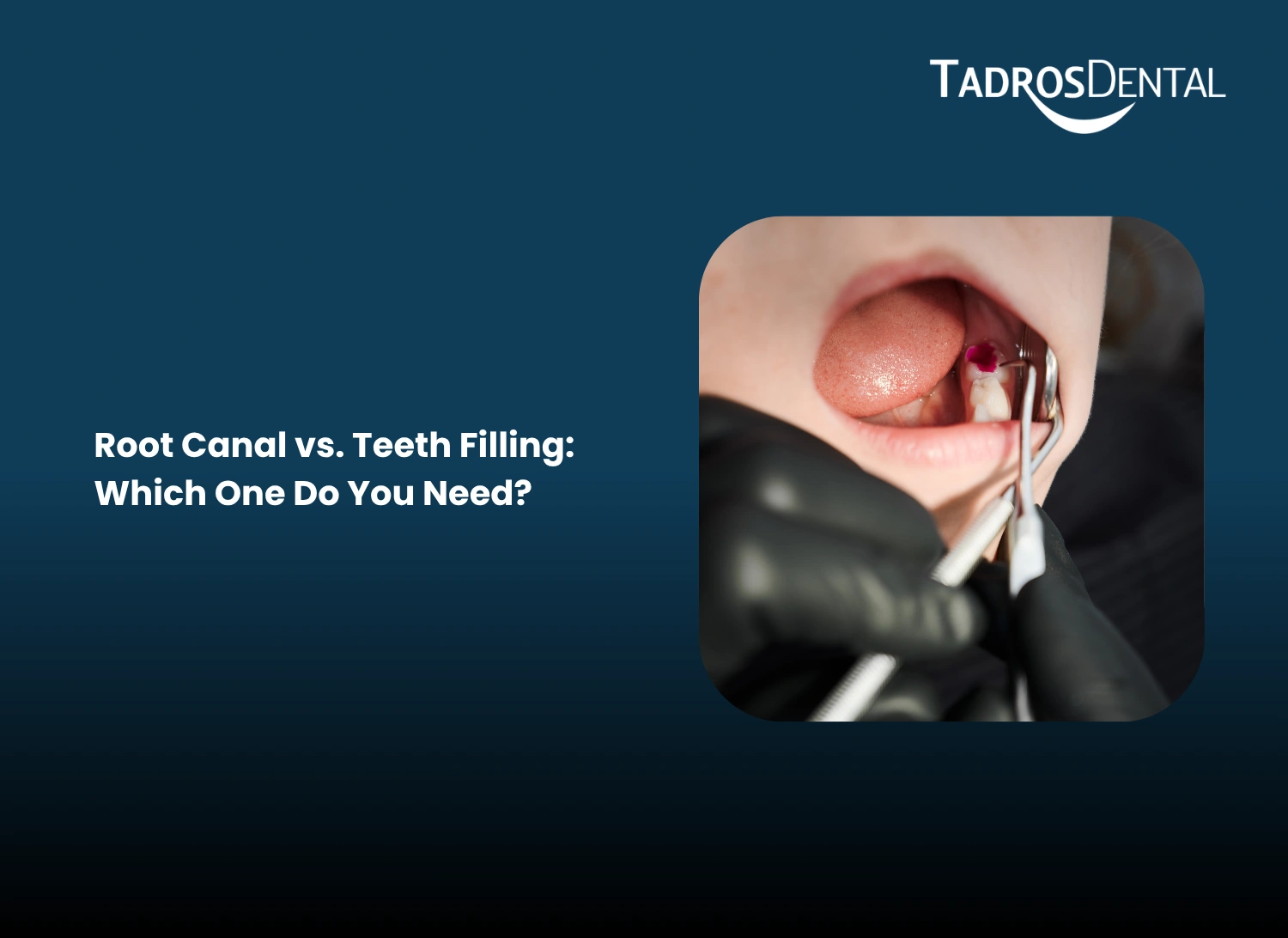 Root Canal vs. Teeth Filling Which One Do You Need