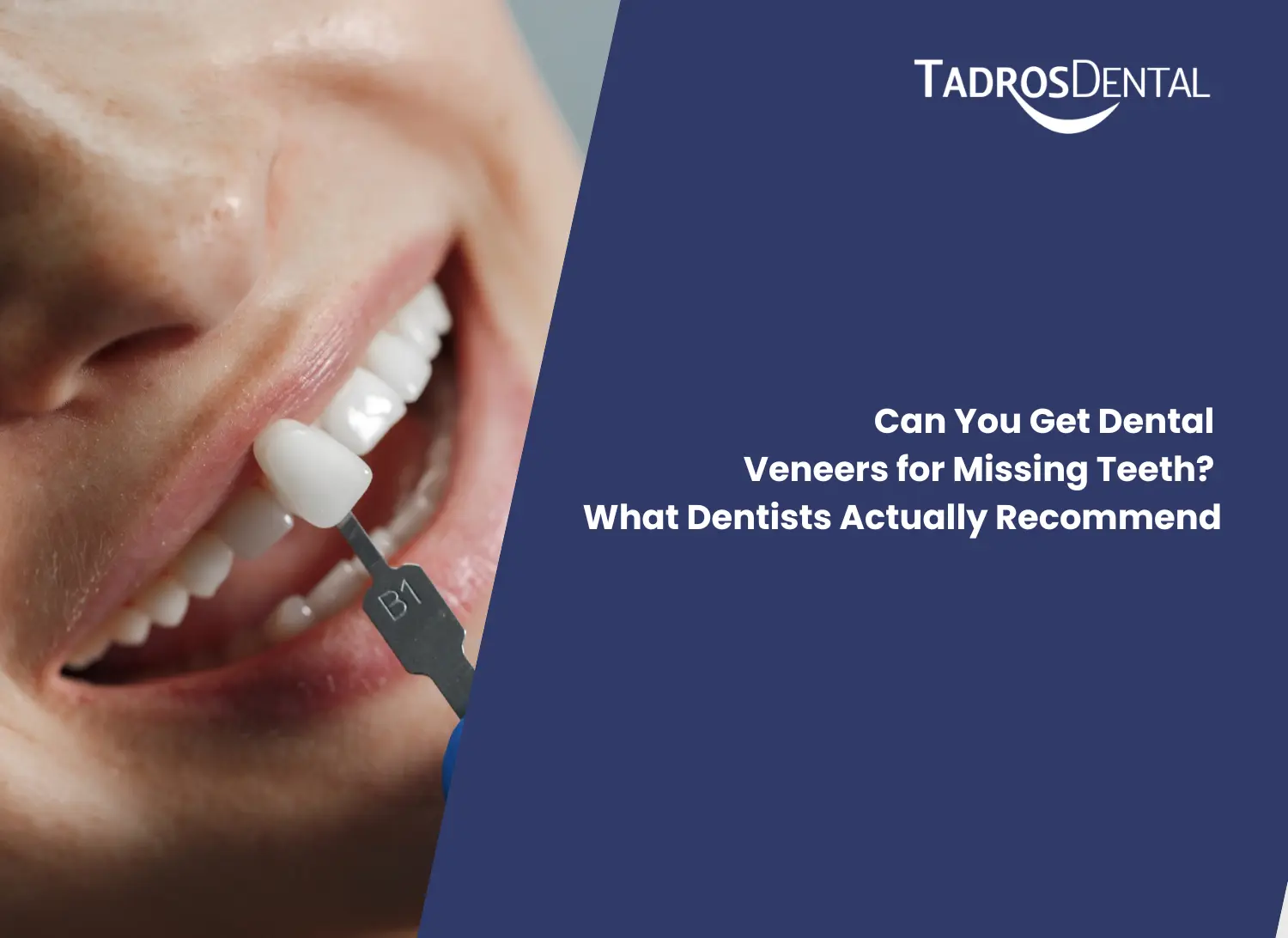 Can You Get Dental Veneers for Missing Teeth? What Dentists Actually Recommend