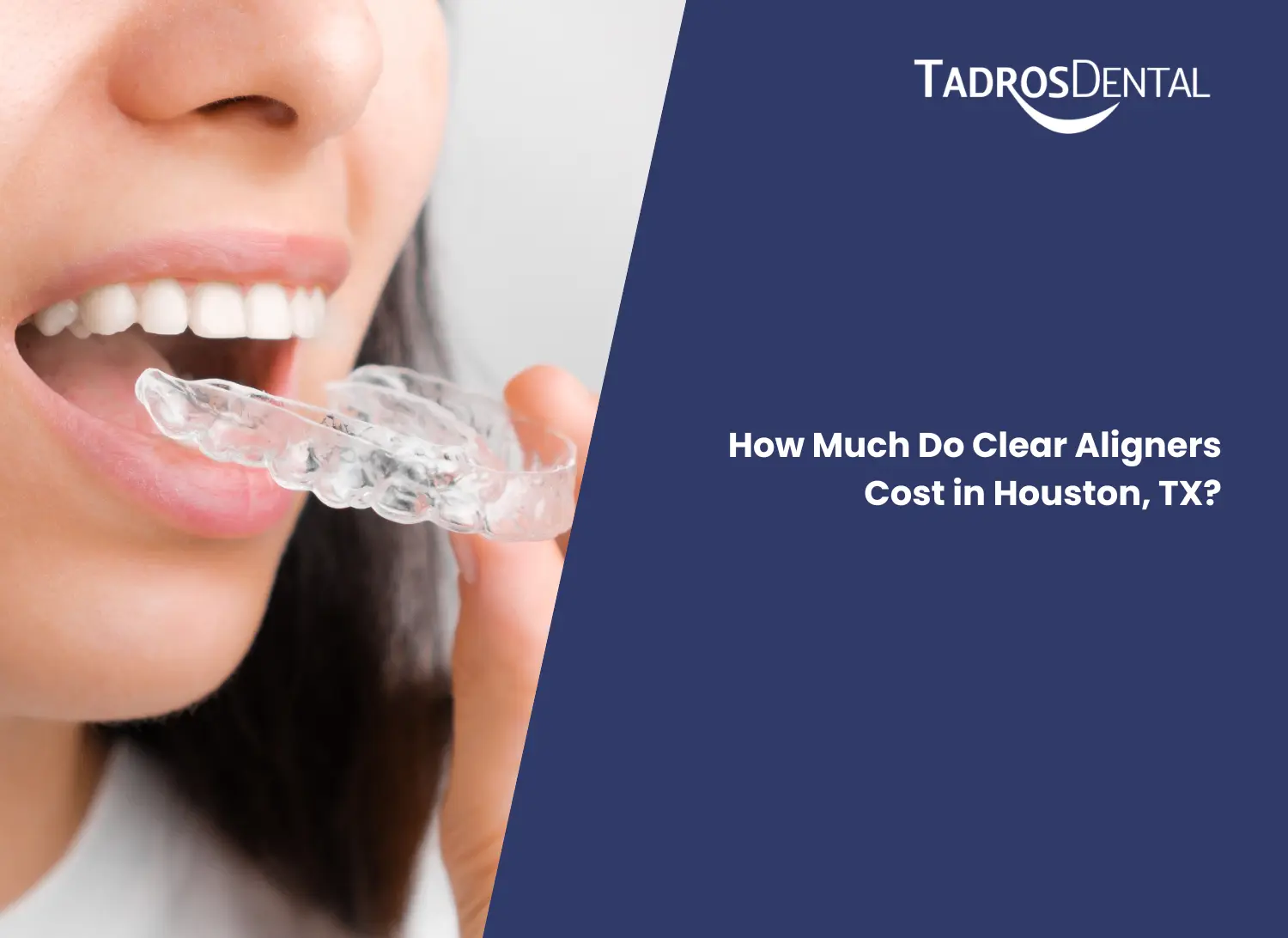 How Much Do Clear Aligners Cost in Houston, TX