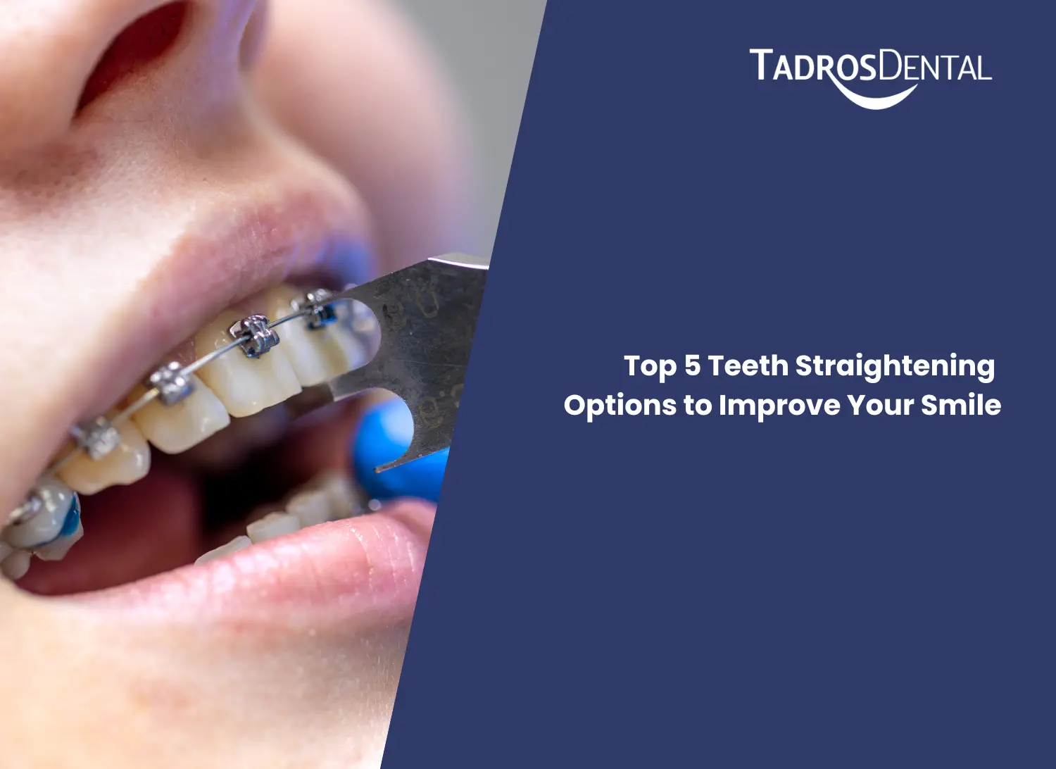 Top 5 Teeth Straightening Options to Improve Your Smile
