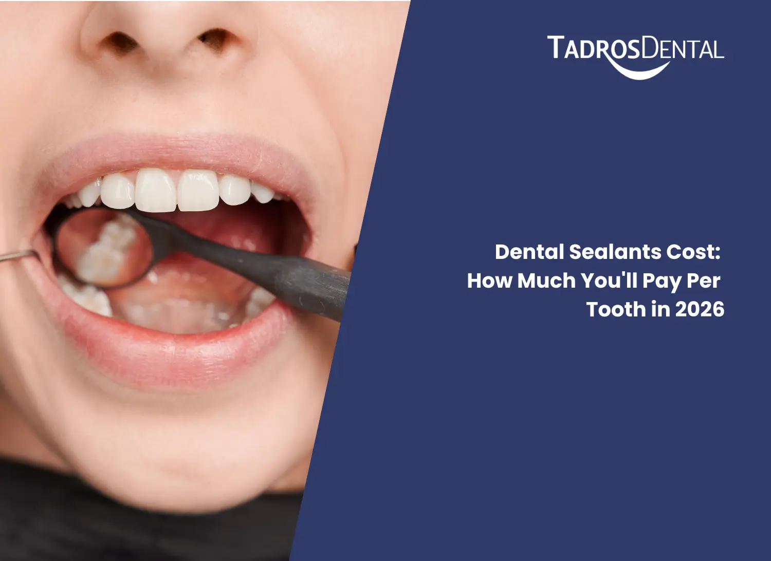 Dental Sealants Cost in houston